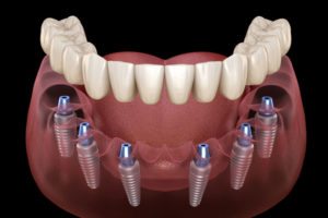 Graphical image of dental implant.
