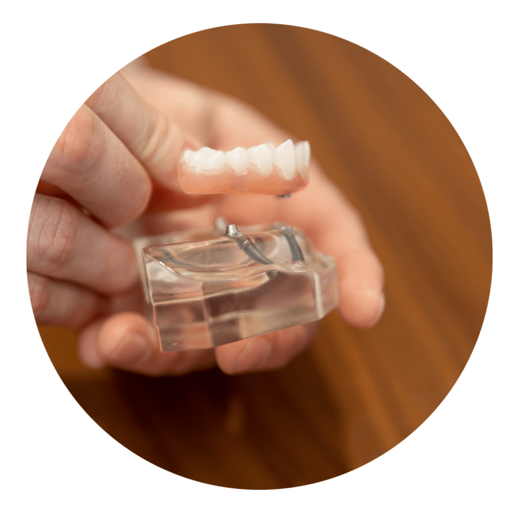 dental implant model