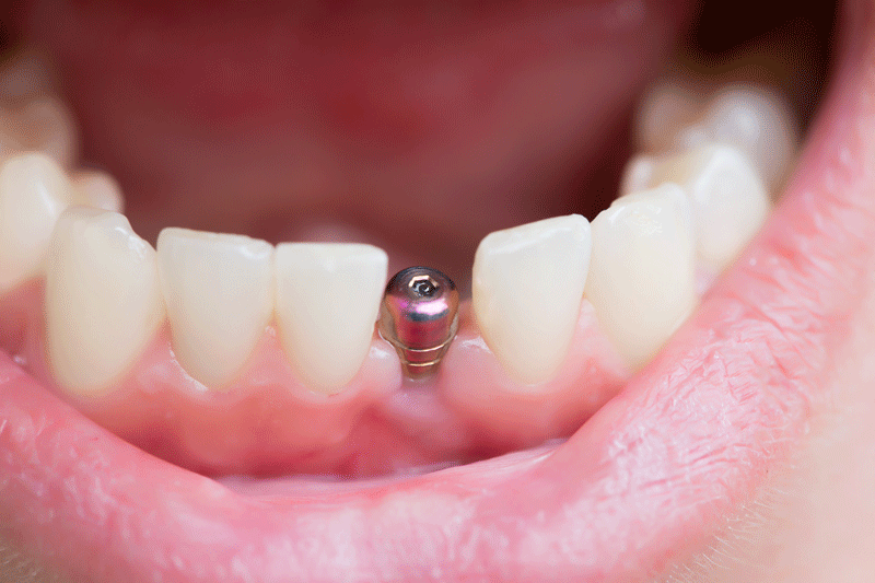 close up shot of a patient’s mouth with a single implant.