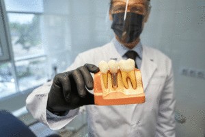 Doctor holding a model of a dental implant