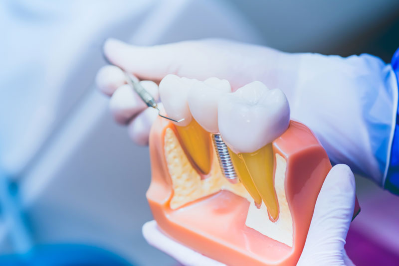 Image of a doctor holding a dental implants model at an angel