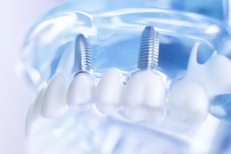 dental implants.