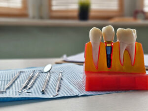 Dental implant, artificial tooth roots into jaw, root canal of dental treatment, gum disease, teeth model for dentist.Dental implant, artificial tooth roots into jaw, root canal of dental treatment, gum disease, teeth model for dentist