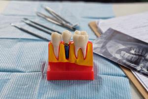 Dental implant, artificial tooth roots into jaw, root canal of dental treatment, gum disease, teeth model for dentist.